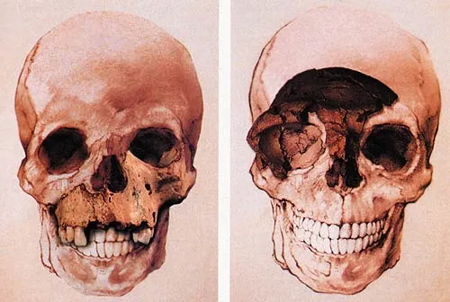 The skull reconstructed from the Atapuerca fossil (left) bears a close resemblance to that of man living today (right).