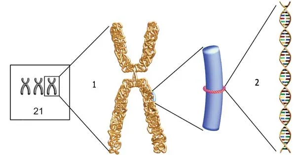 1- Extra 21st chromosome, 2- Gart gene. Our cells have 23 pairs of chromosomes. If these pairs possess more chromosomes for any reason, their equilibrium will b